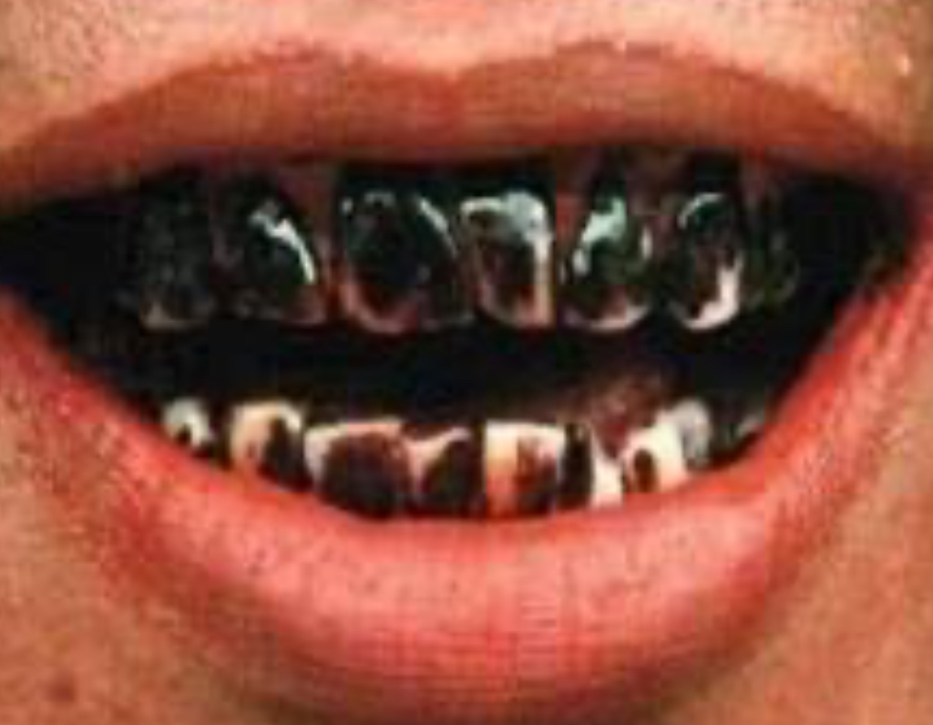 Severely stained teeth from chronic areca nut use